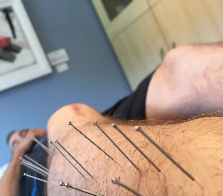 what is dry needling in physical therapy