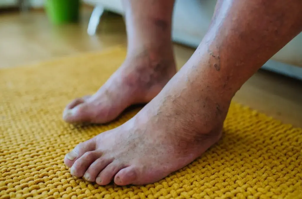 diabetic-feet